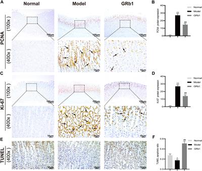 Ginsenoside Rb1 Lessens Gastric Precancerous Lesions by Interfering With β-Catenin/TCF4 Interaction